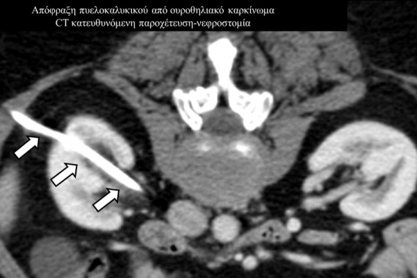 Απόφραξη πυελοκαλυκικού από ουροθηλιακό καρκίνωμα / CT κατευθυνόμενη νεφροστομία