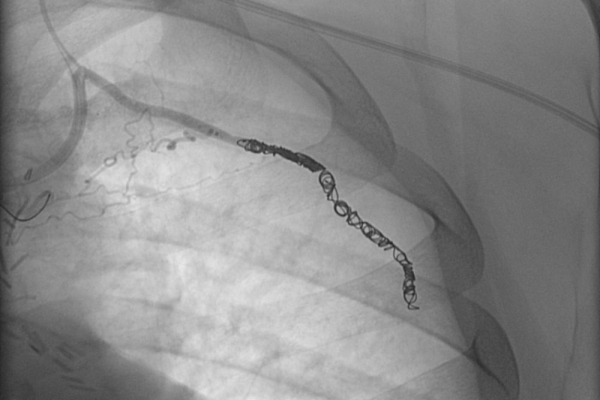 εμβολισμός μεσοπλεύριου κλάδου με coils σε ασθενή με φαινόμενο υποκλοπής από καρδιακό bypass έσω μαστικής