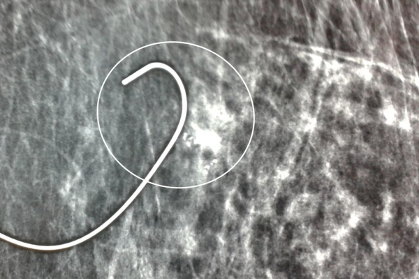 Στερεοτακτική σήμανση hook-wire σε DCIS καρκίνωμα μαστού