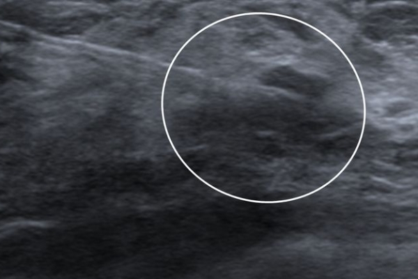 Υπερηχογραφική σήμανση hook-wire σε DCIS καρκίνωμα μαστού