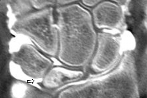 CT αρθρογραφία πηχεοκαρπικής / Νόσος Kienbock με ρήξη πυραμομηνοειδή συνδέσμου